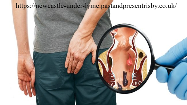 8 Faktor Penyebab Ambeien Luar yang Perlu Anda Ketahui